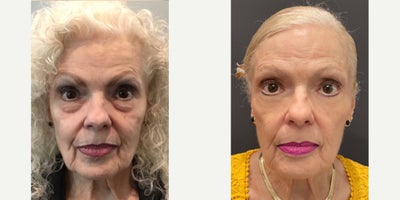 Eyelid Surgery before and after photo