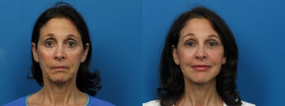 Facelift before and after photo