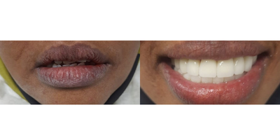 Smile Makeover before and after photo