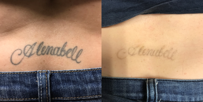 Tattoo Removal before and after photo