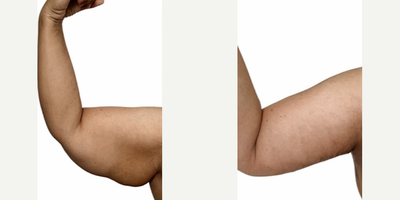 Arm Lift before and after photo