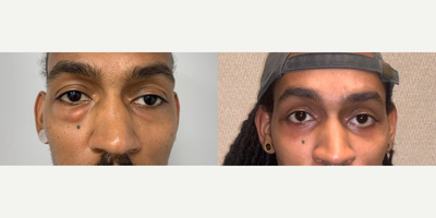 Eyelid Surgery before and after photo