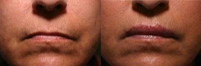 Lip Fillers before and after photo