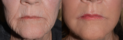 Skin Rejuvenation before and after photo