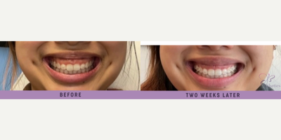Botox for Gummy Smile before and after photo