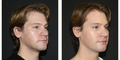Facial Fat Transfer before and after photo