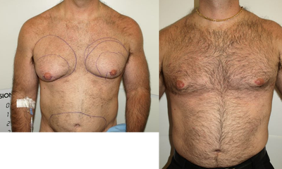Gynecomastia Surgery before and after photo