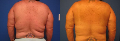 Liposuction before and after photo