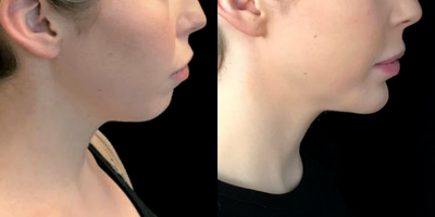 Chin Implant before and after photo