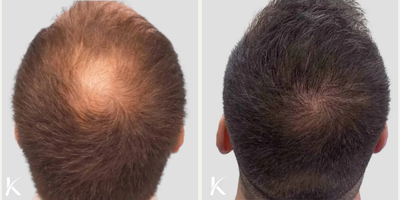 FUE Hair Transplant before and after photo