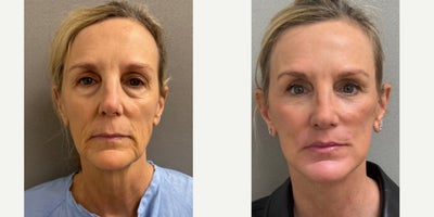 Neck Lift before and after photo