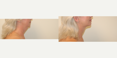 Smart Lipo before and after photo