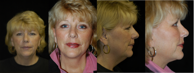 Facelift before and after photo