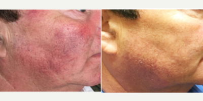 IPL before and after photo