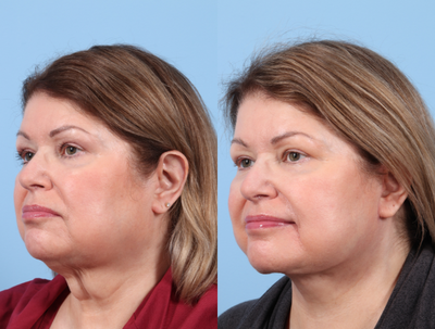 Neck Lift before and after photo