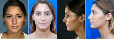 Rhinoplasty before and after photo