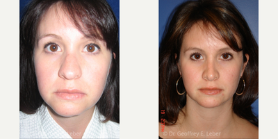 Rhinoplasty before and after photo