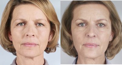 Sculptra before and after photo