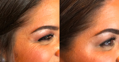 Botox before and after photo