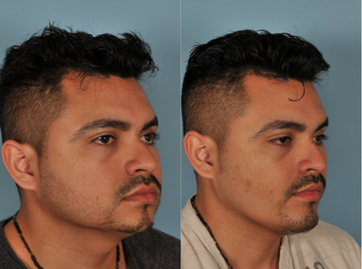 Chin Implant before and after photo