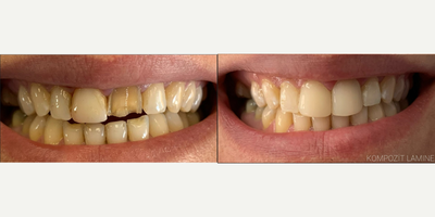 Dental Crown before and after photo