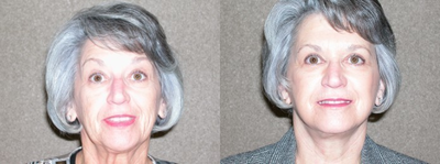 Facelift before and after photo
