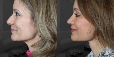 Facelift before and after photo