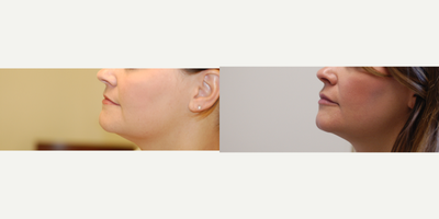Lip Fillers before and after photo