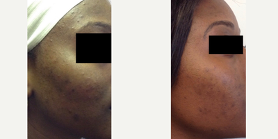 PicoWay before and after photo