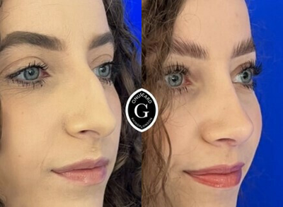 Rhinoplasty before and after photo