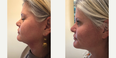 Dermal Fillers before and after photo