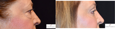 Eyelid Surgery before and after photo