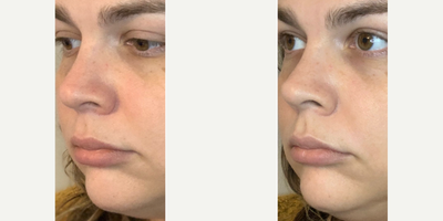 HydraFacial before and after photo