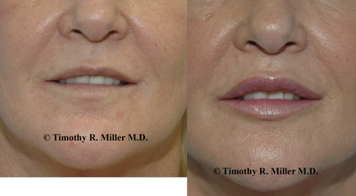 Juvederm before and after photo