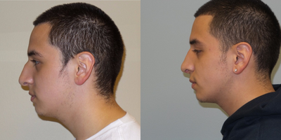 Rhinoplasty before and after photo