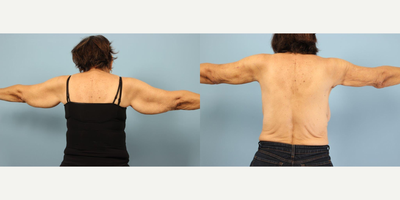 Arm Lift before and after photo