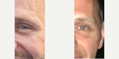 Botox before and after photo