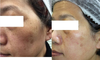 Fractional Laser before and after photo