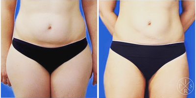 Liposuction before and after photo