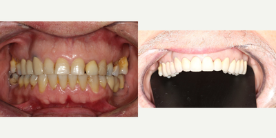 Tooth Repair before and after photo