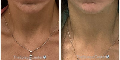 Botox before and after photo