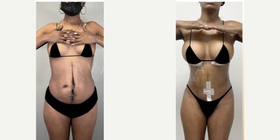 Breast Augmentation before and after photo