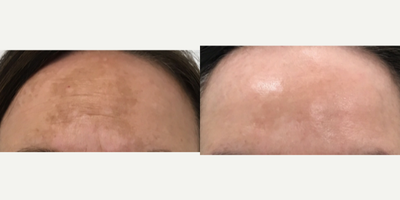 Clear and Brilliant before and after photo