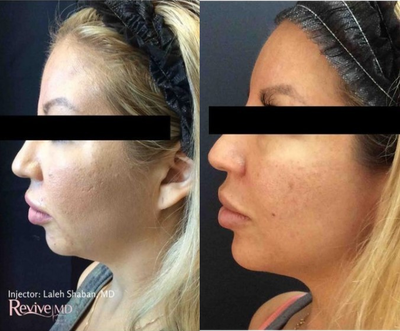 Restylane before and after photo