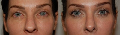 Rhinoplasty before and after photo