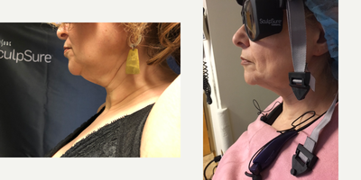 SculpSure before and after photo