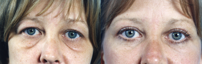 Eyelid Surgery before and after photo