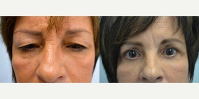 Eyelid Surgery before and after photo