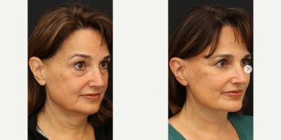 Eyelid Surgery before and after photo