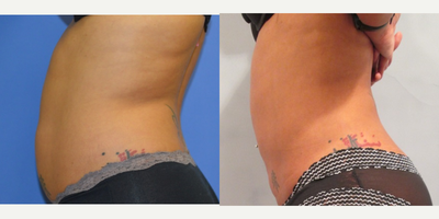 Liposuction before and after photo